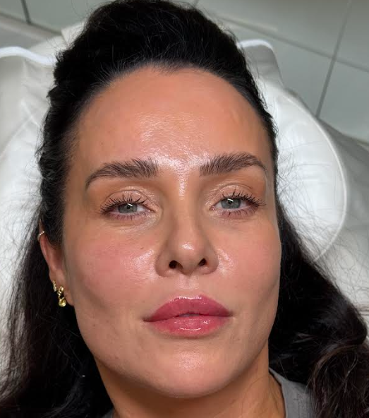 Subtle lip filler result with natural volume and definition