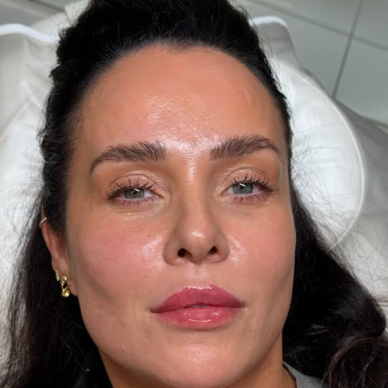 Subtle lip filler result with natural volume and definition