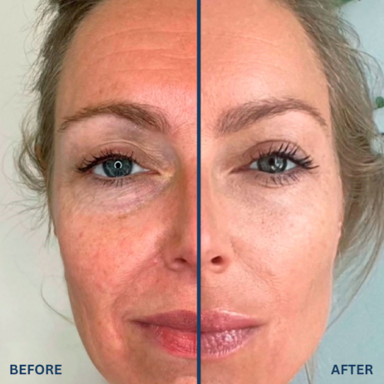 skin boosters
